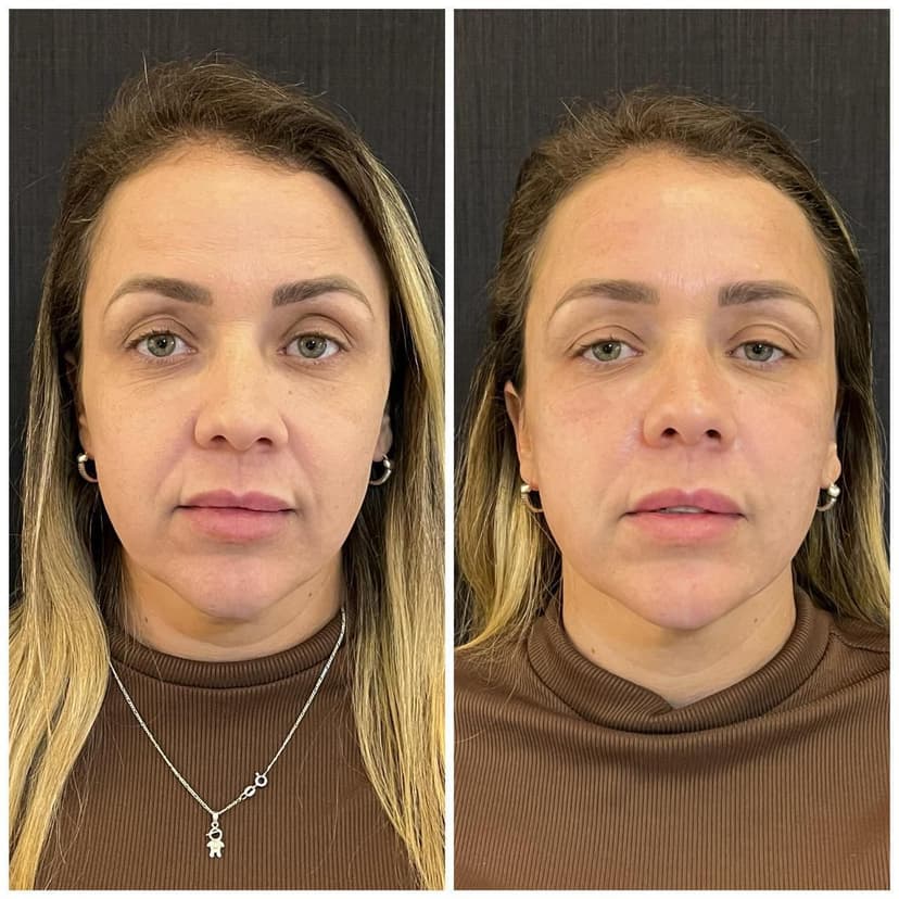 Ultrassom microfocado corporal para flacidez na Clínica Fernanda Rabelo em Goiânia