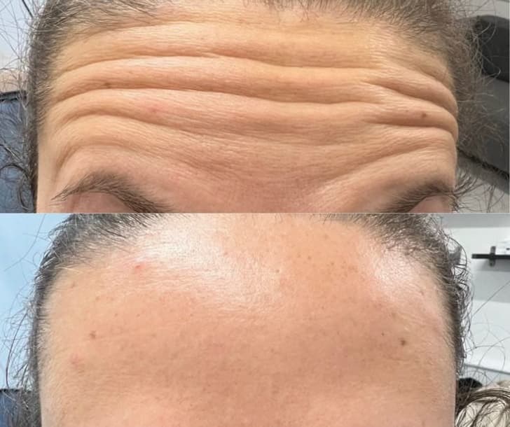 Toxina botulínica para rugas e linhas de expressão na Clínica Fernanda Rabelo em Goiânia