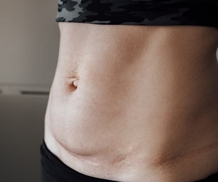 Tratamento de diástase abdominal em clínica de estética em Aparecida de Goiânia