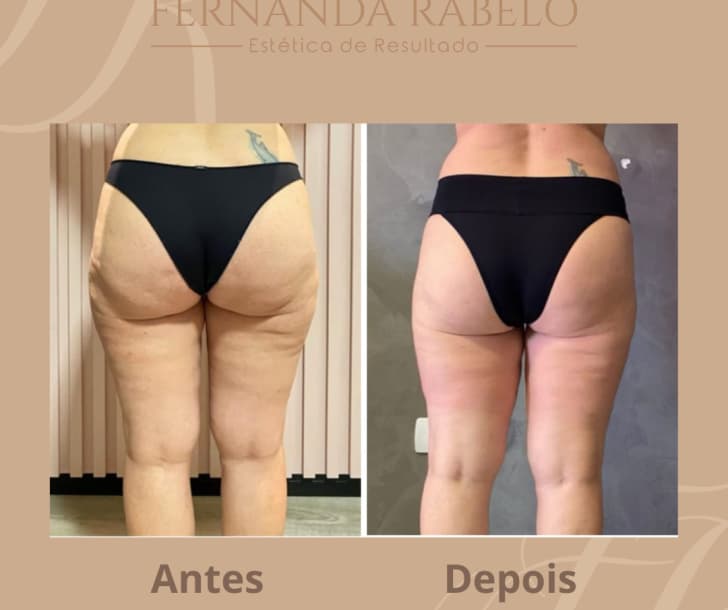 Tratamento para flacidez corporal e facial na Clínica Fernanda Rabelo