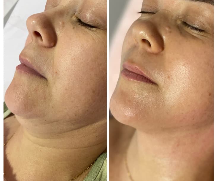 Enzimas para papada e definição do perfil na Clínica Fernanda Rabelo em Goiânia