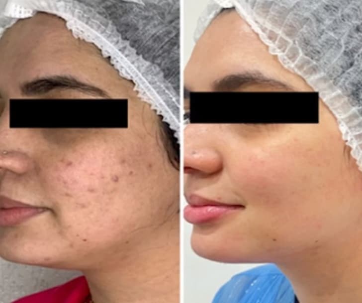 Microagulhamento facial para rejuvenescimento da pele na Clínica Fernanda Rabelo