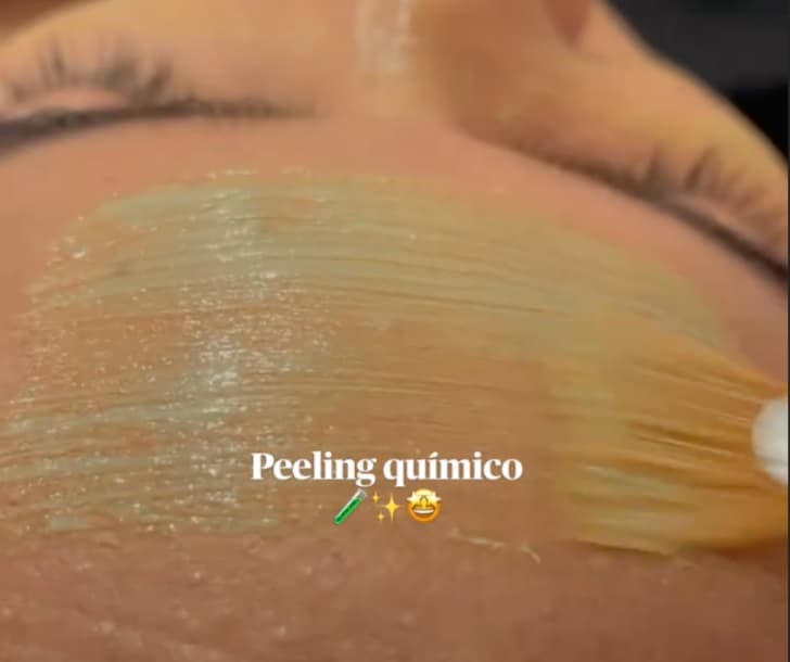 Peelings faciais para renovação celular na Clínica Fernanda Rabelo em Goiânia