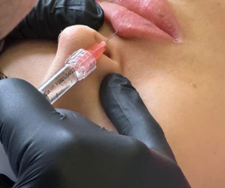 Preenchimento labial com ácido hialurônico em clínica de estética em Goiânia