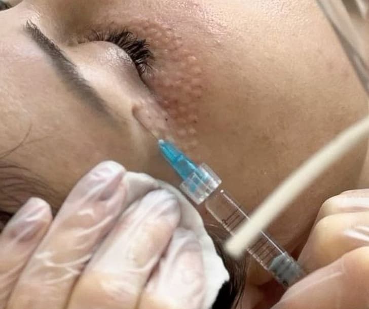 Skinbooster para hidratação profunda da pele em clínica de estética em Goiânia