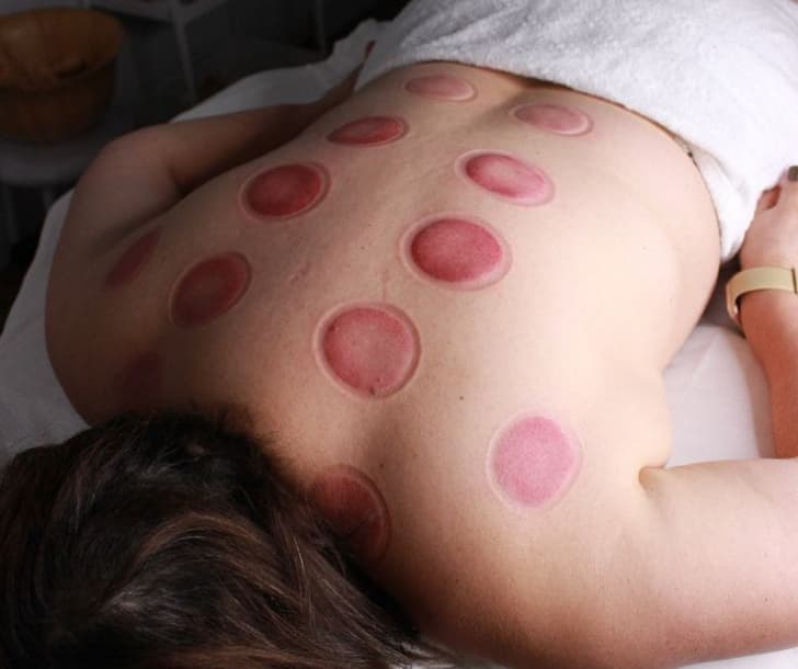 Ventosaterapia corporal para redução de celulite na Clínica Fernanda Rabelo